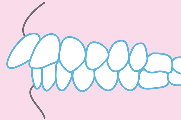 出っ歯のイラスト