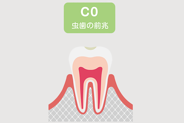 虫歯Coの状態