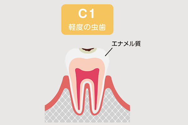 虫歯C1の状態
