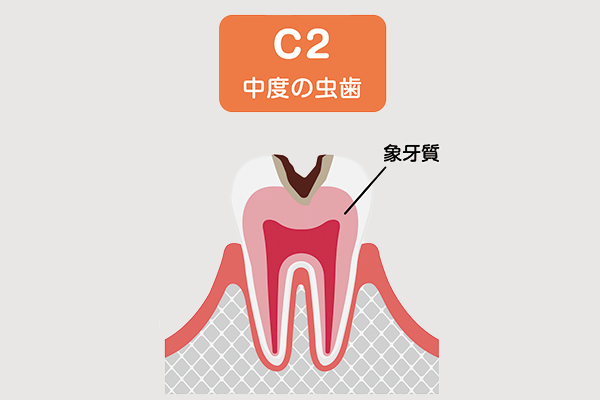 虫歯C2の状態