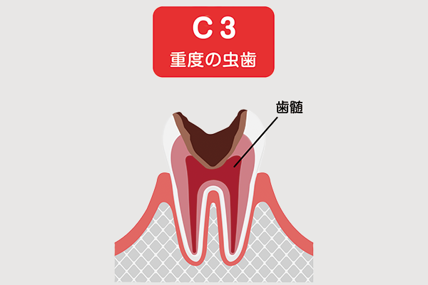 虫歯C3の状態
