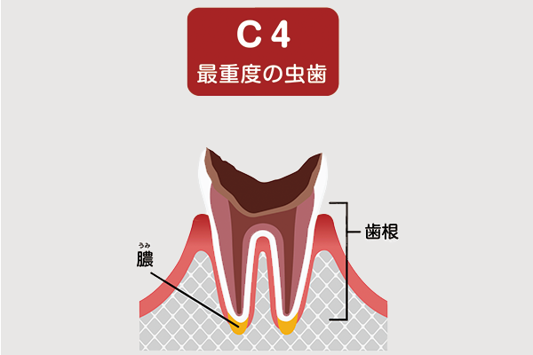 虫歯C4の状態